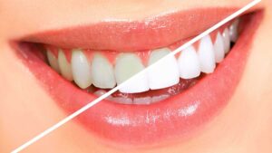 Подробнее о статье Отбеливание зубов в Краснодаре