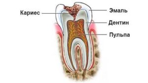 Подробнее о статье Глубокий кариес: лечение и профилактика