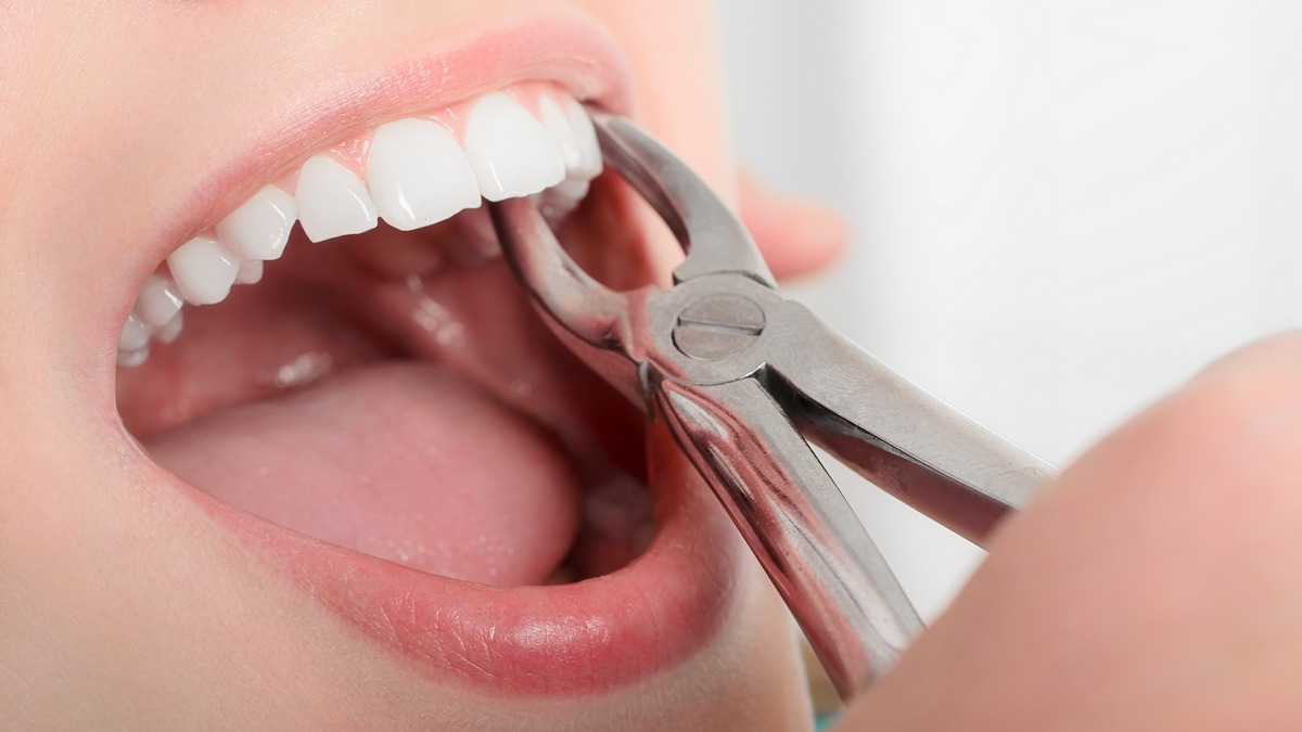 Подробнее о статье Удаление зубов в Краснодаре