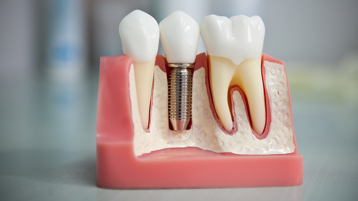 Подробнее о статье Имплантация зубов в Краснодаре