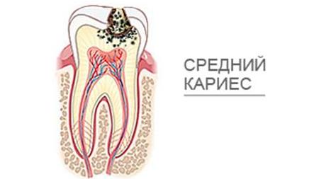 Подробнее о статье Средний кариес: лечение и профилактика