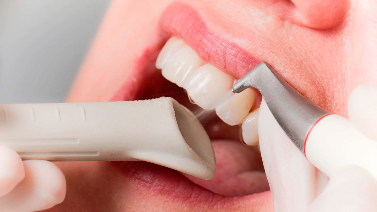 Подробнее о статье Что представляет собой чистка зубов методом Air Flow