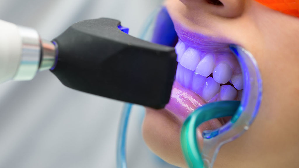 Подробнее о статье Безвредное осветление зубов в стоматологии