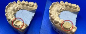 Подробнее о статье Восстановление зуба керамической вкладкой