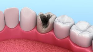 Подробнее о статье Лечение разрушенного зуба