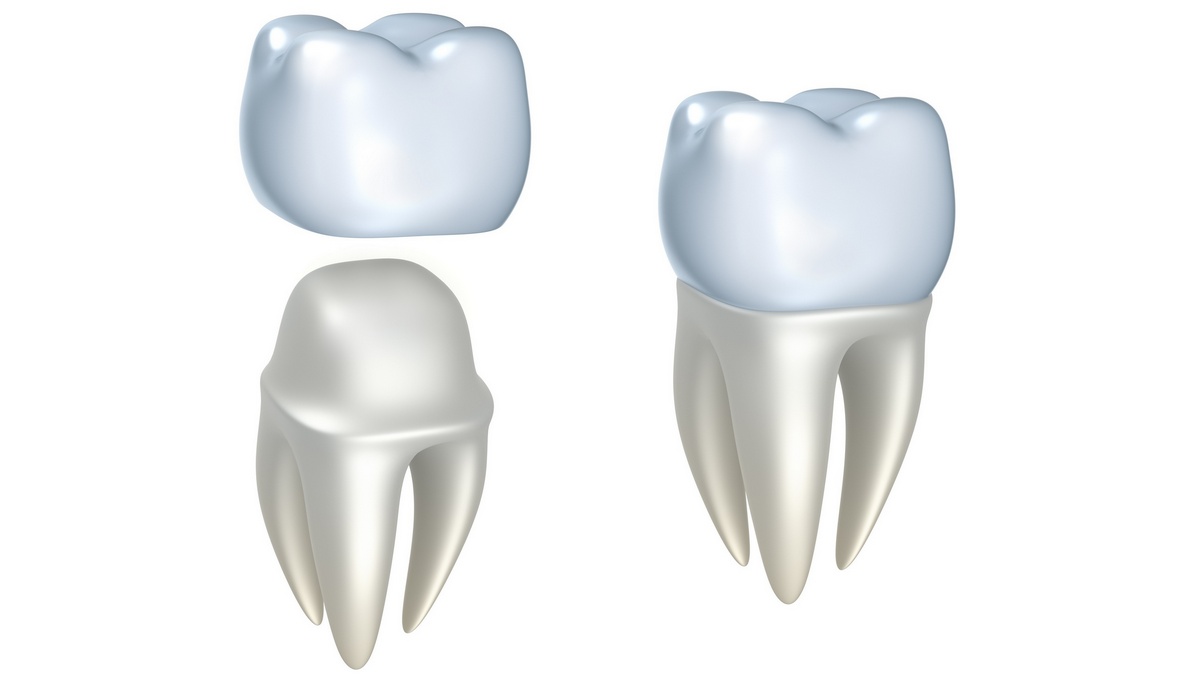 Подробнее о статье Металлокерамические зубные коронки