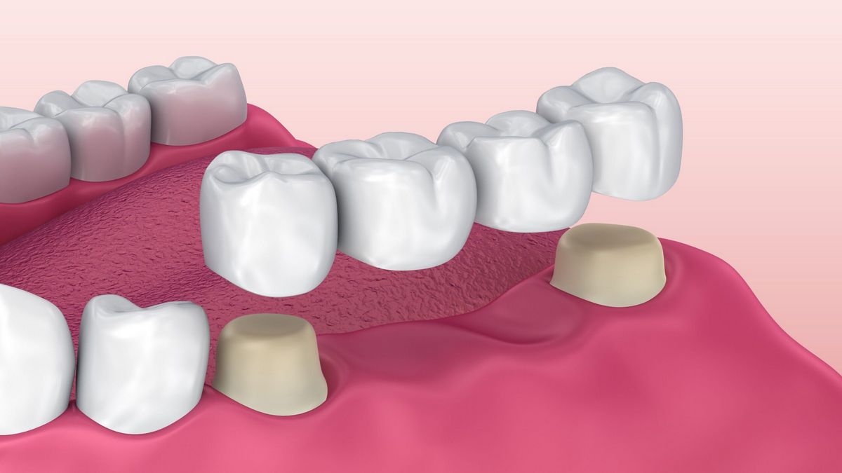 Вы сейчас просматриваете Мостовидные протезы в стоматологии – когда они нужны?