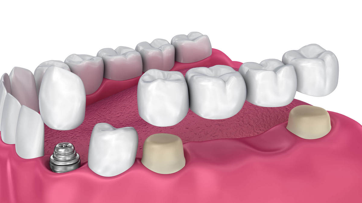 Подробнее о статье Нет одного зуба: варианты восстановления (мостовидный протез)