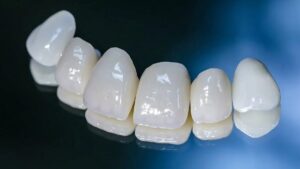 Подробнее о статье Преимущества циркониевых зубных коронок