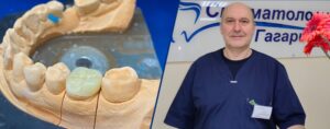 Подробнее о статье Реставрация зуба