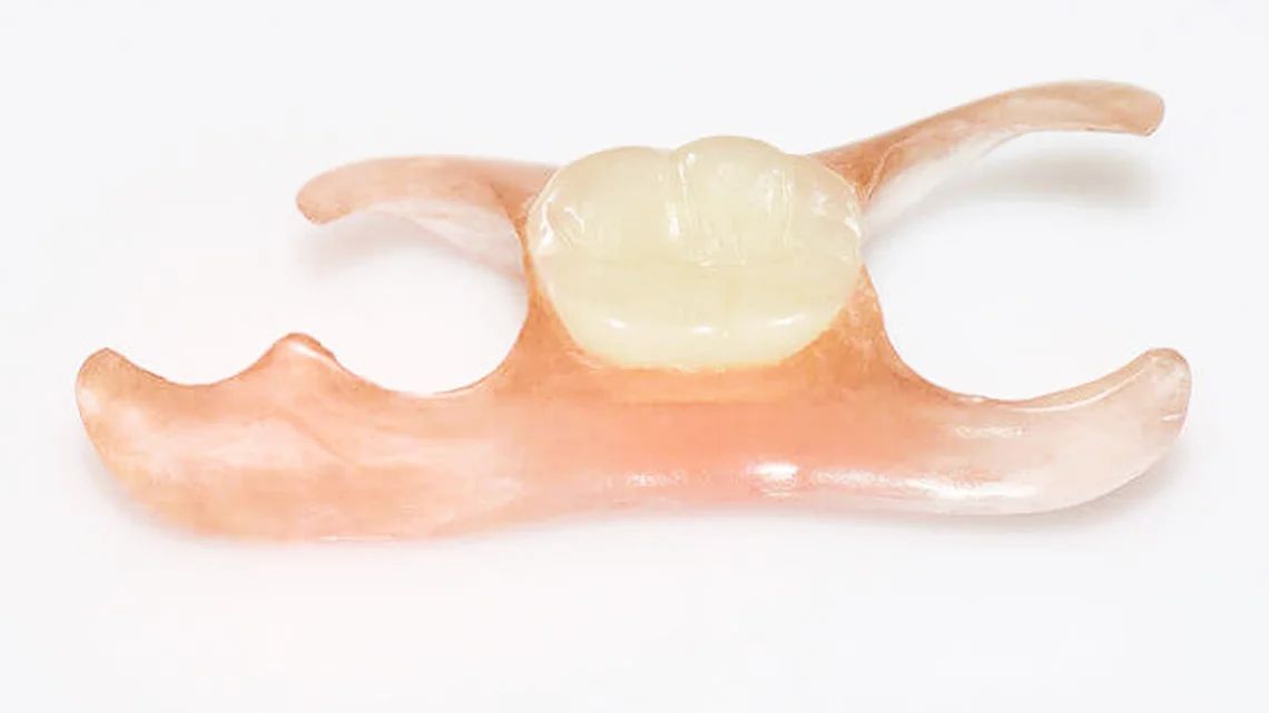 Вы сейчас просматриваете Протезирование при отсутствии одного зуба: иммедиат-протез