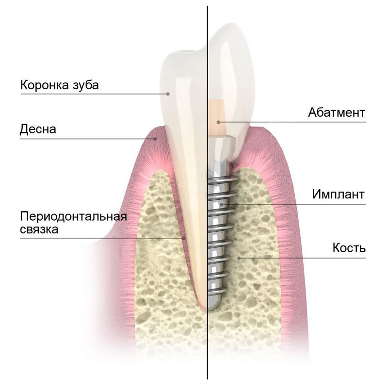 Схема установки зубного импланта