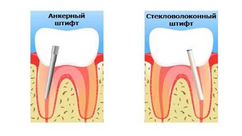 Подробнее о статье Как сохранить корень зуба? Укрепление корня зуба штифтом