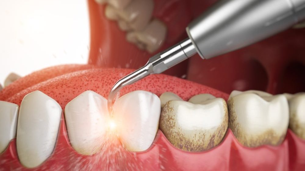 Подробнее о статье Удаление зубного камня