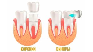 Подробнее о статье Виниры или коронки?