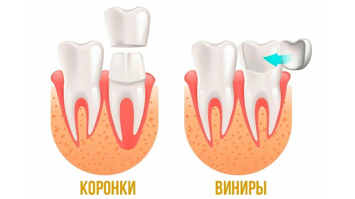 Вы сейчас просматриваете Виниры или коронки?