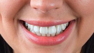 Подробнее о статье Восстановление передних зубов после травмы металлокерамическими коронками