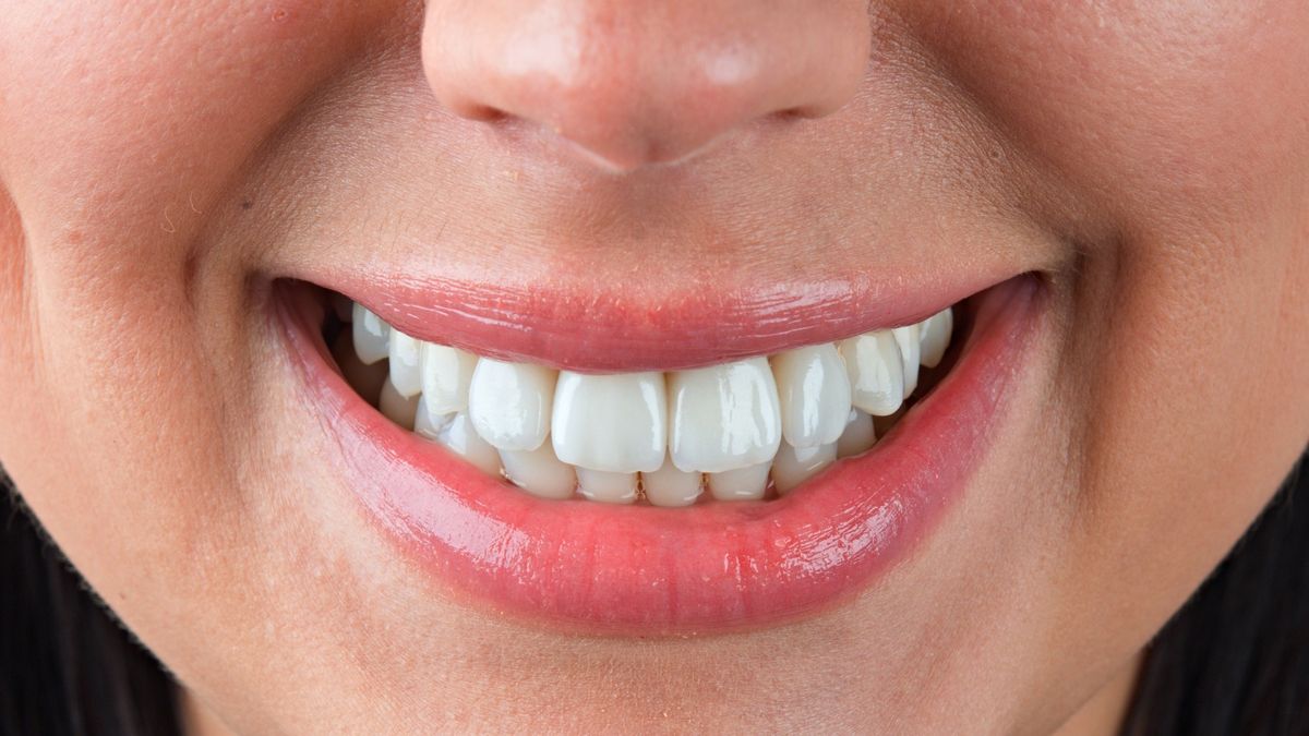 Вы сейчас просматриваете Восстановление передних зубов после травмы металлокерамическими коронками