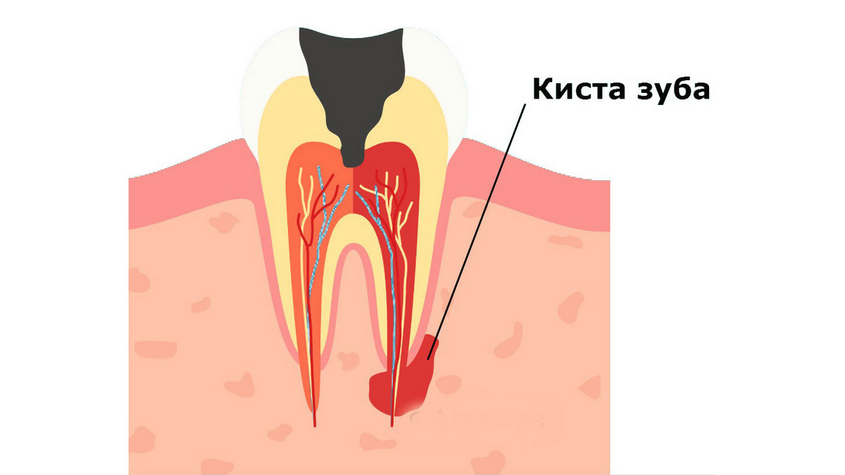 Вы сейчас просматриваете Лечение кисты зуба в Краснодаре