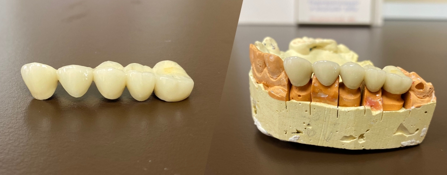 Зубной протез из металлокерамики – особенности, разновидности, плюсы и минусы, цены